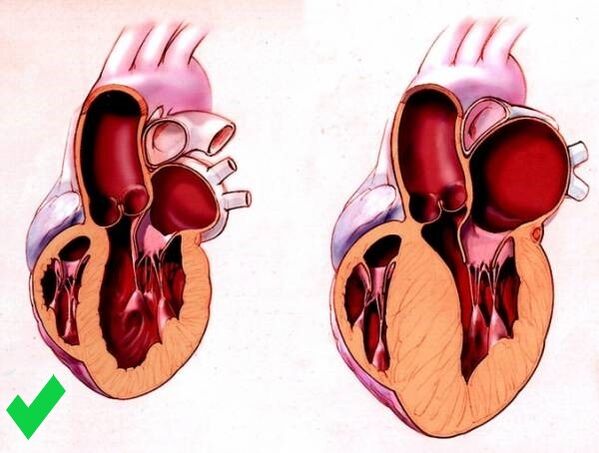 Cardione voorkomt ventriculaire hypertrofie van het hart